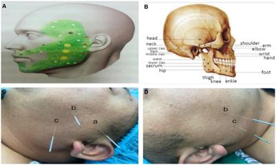 Effects of buccal acupuncture on postoperative analgesia in elderly patients undergoing laparoscopic radical gastrectomy: a randomized controlled trial